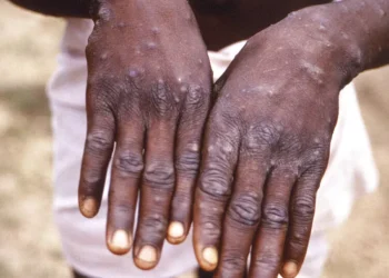 La République centrafricaine et le Kenya confirment des foyers de variole