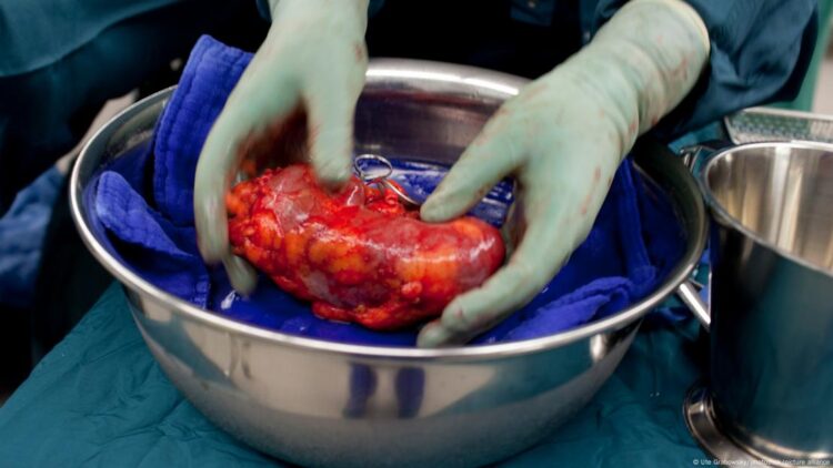 تقرير: تجارة الأعضاء البشرية تصل إلى أبعاد وبائية في إفريقيا