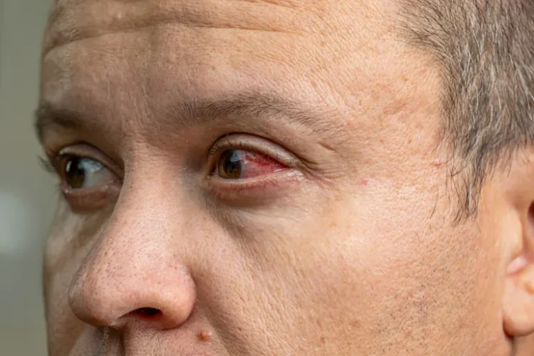 تحذير عاجل للمسافرين من تفشي مرض معدٍ يسبب نزيفا بالعين في تنزانيا